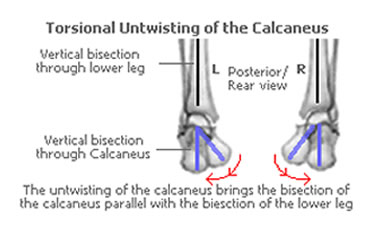 Foot Shape Variations of the rearfoot are controlled by torsional untwisting of the calcaneus (heelbone)