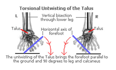 Foot Shape Variations of the forefoot are controlled by torsional untwisting of the talus