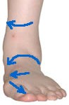 Hyperpronation caused by a natural varus deformity forces the foot to roll inward and downward