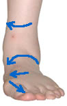 Hyperpronation caused by a natural varus deformity forces the foot to roll inward and downward