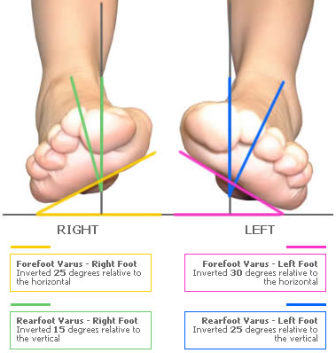 Foot shape assessment example shown identifies severe bilateral forefoot and rearfoot varus deformity
