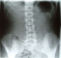 root2being author xray showing functional scoliosis
